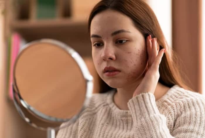 Acne Treatment: Adopt 8 Diet Options to Get Clear Skin