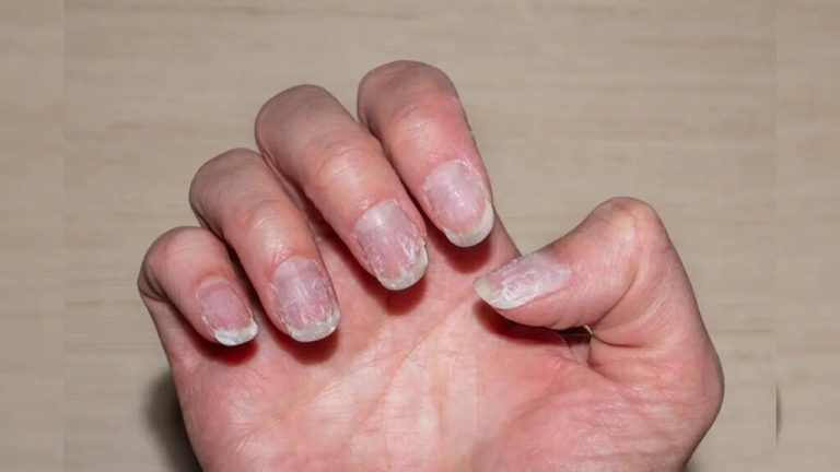 Broken, cracked and torn nails can spoil your impression, they are a sign of these diseases: Nail Indicate Bad Health