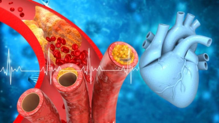 High Cholesterol: How do you understand that cholesterol has increased without doing a test? Don't ignore the 3 symptoms