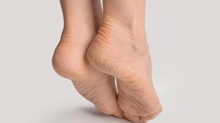 If your feet also crack in summer then these remedies will be useful: Footcare in Summer