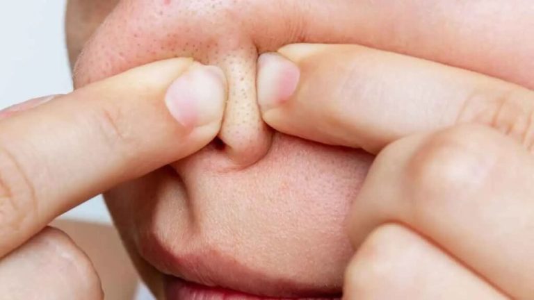 Remove blackheads on the nose easily, just follow these home remedies  | Live Updates, Unveiling the Latest India News Trends – ..