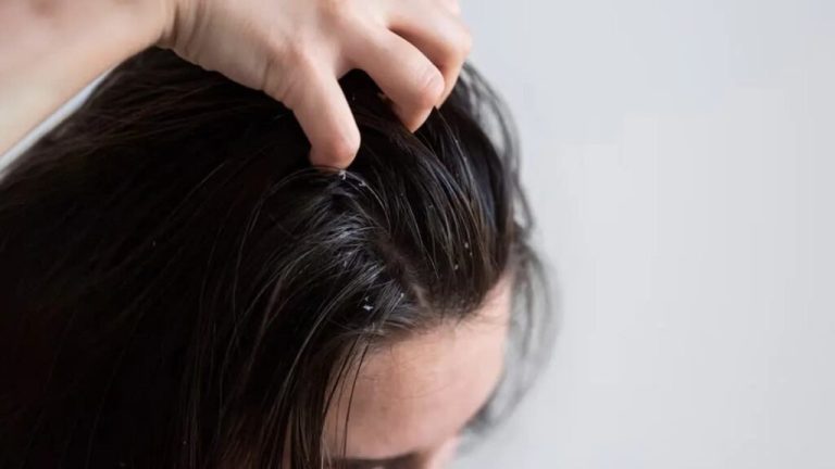 If you are troubled by dandruff problem in summer, then follow these tips – ..