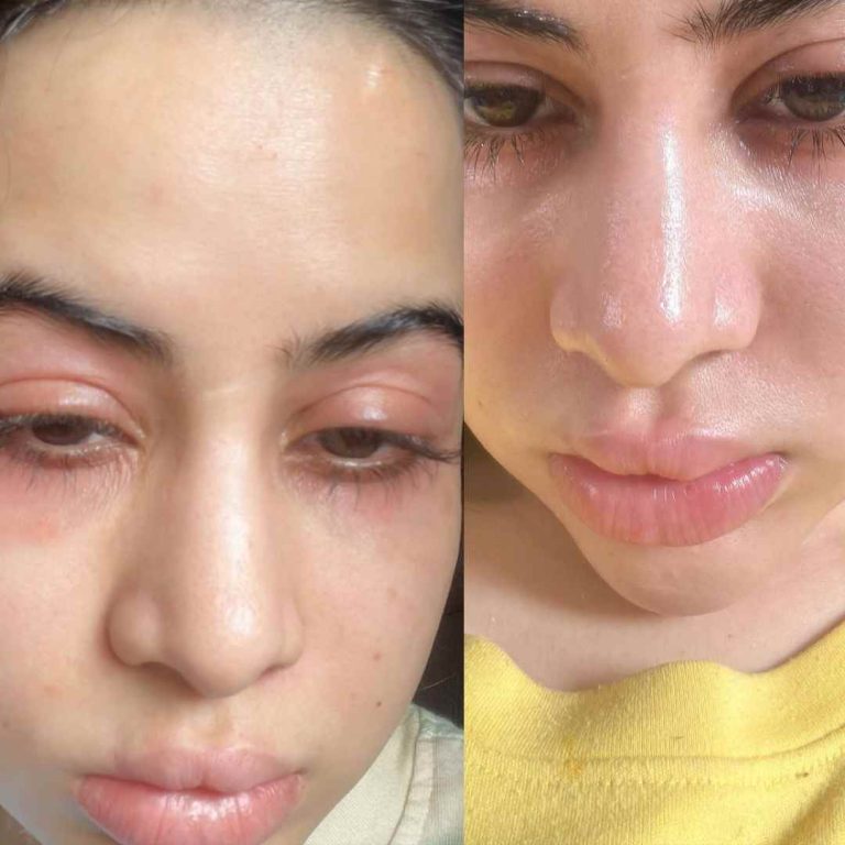 Uorfi Javed Clarifies Swollen Face Concerns: Not Fillers, But Allergies