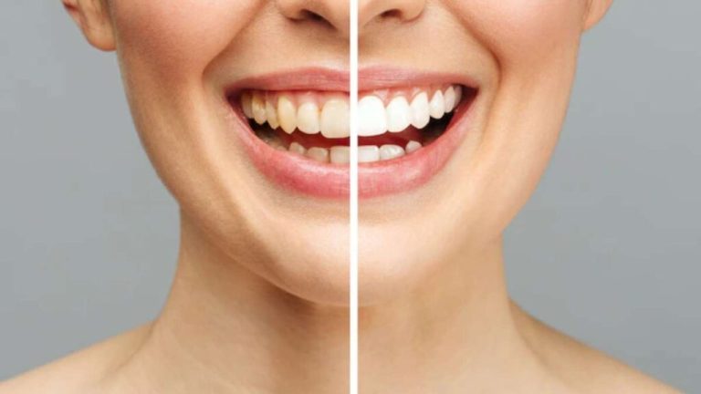 By adopting these 3 home remedies, the yellowness of your teeth will go away in minutes