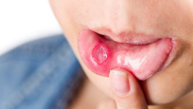 If you are troubled by mouth ulcers, then first know its causes and ways to avoid it