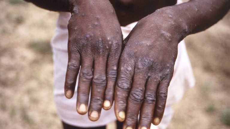 First case of monkeypox found in India, suspected patient in isolation, know what is the latest update?